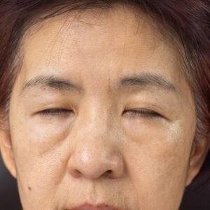Periorbital Oedema: Can Kobido Help Reduce Under-Eye Bags?